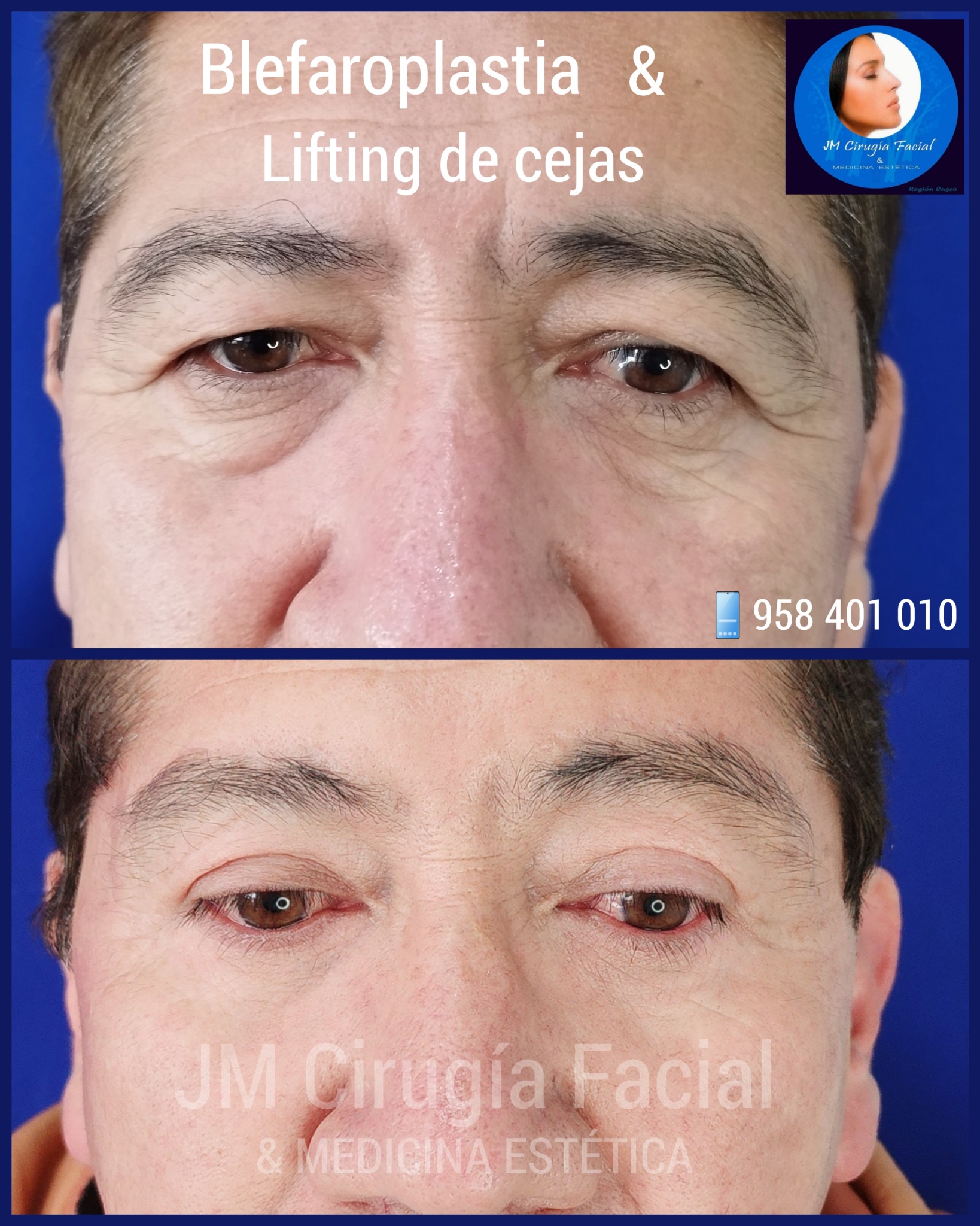 Blefaroplastia y lifting de cejas
