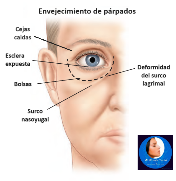 Envejecimiento de párpados