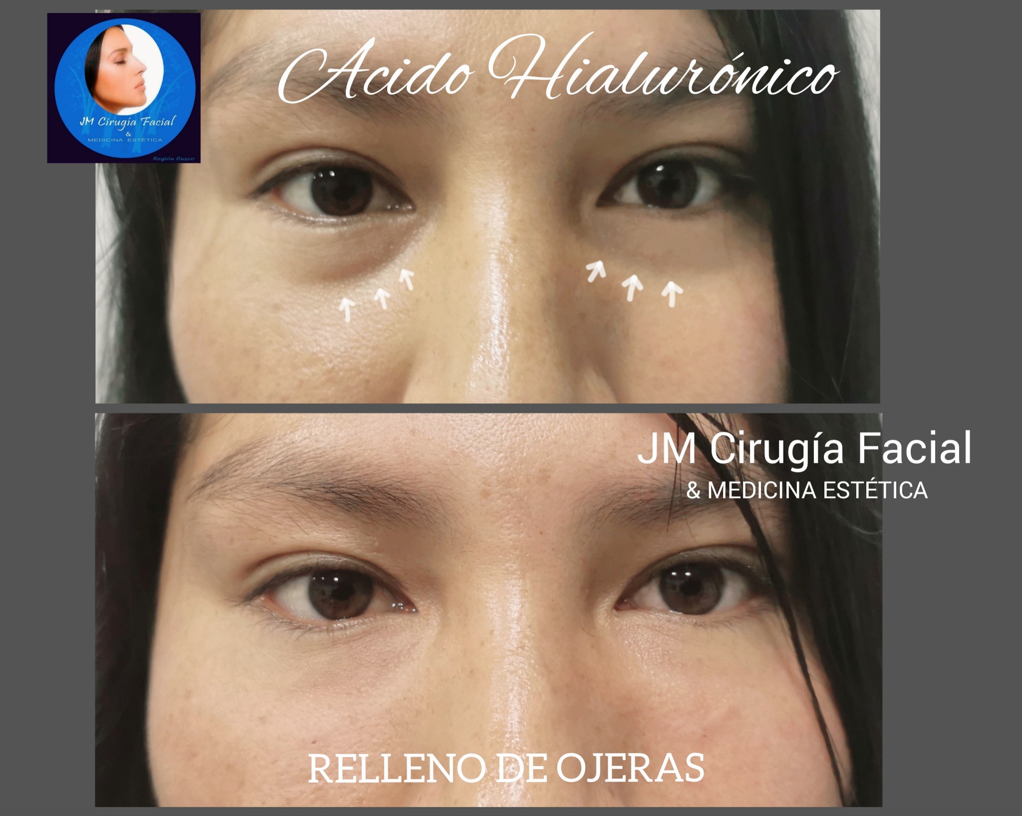 Relleno de ojeras con ácido hialurónico