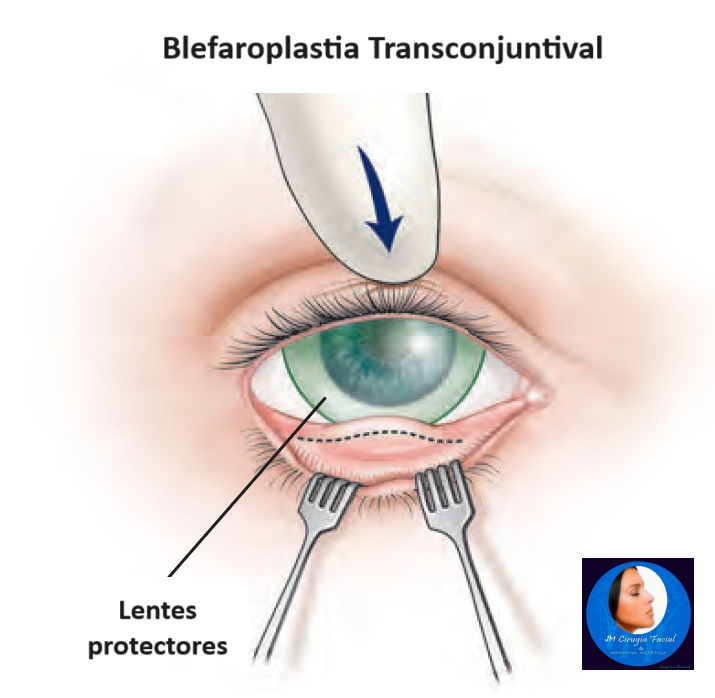 Blefaroplastia transconjuntival