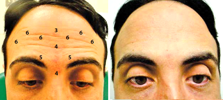 Zonas de aplicación de Botox