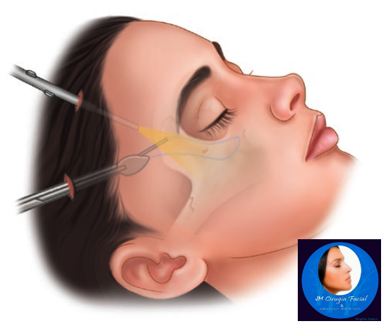 Cirugía endoscópica de cejas