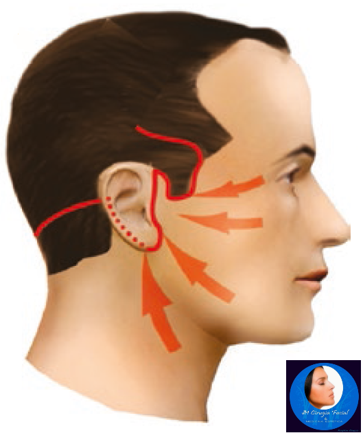 Zonas de incisión lifting facial y cervical