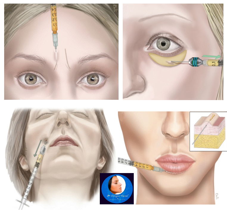 Lugares de lipoinyección facial