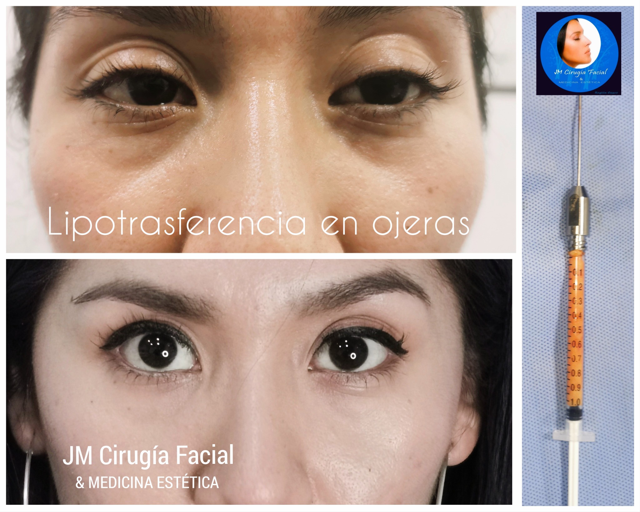 Lipotransferencia en ojeras
