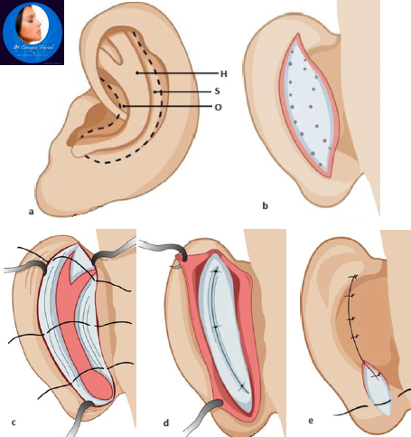 Pasos de otoplastia