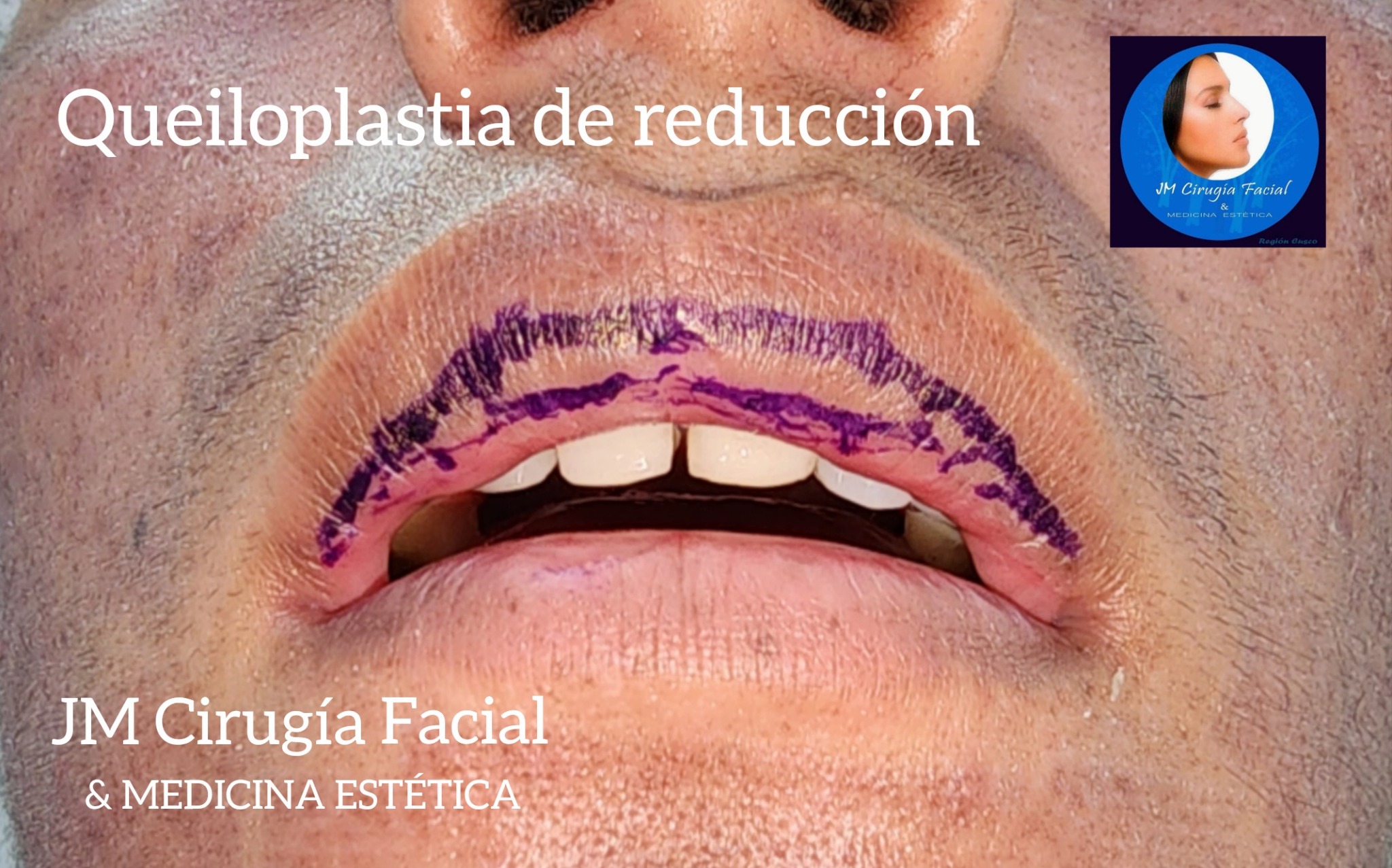 Queiloplastia de reducción