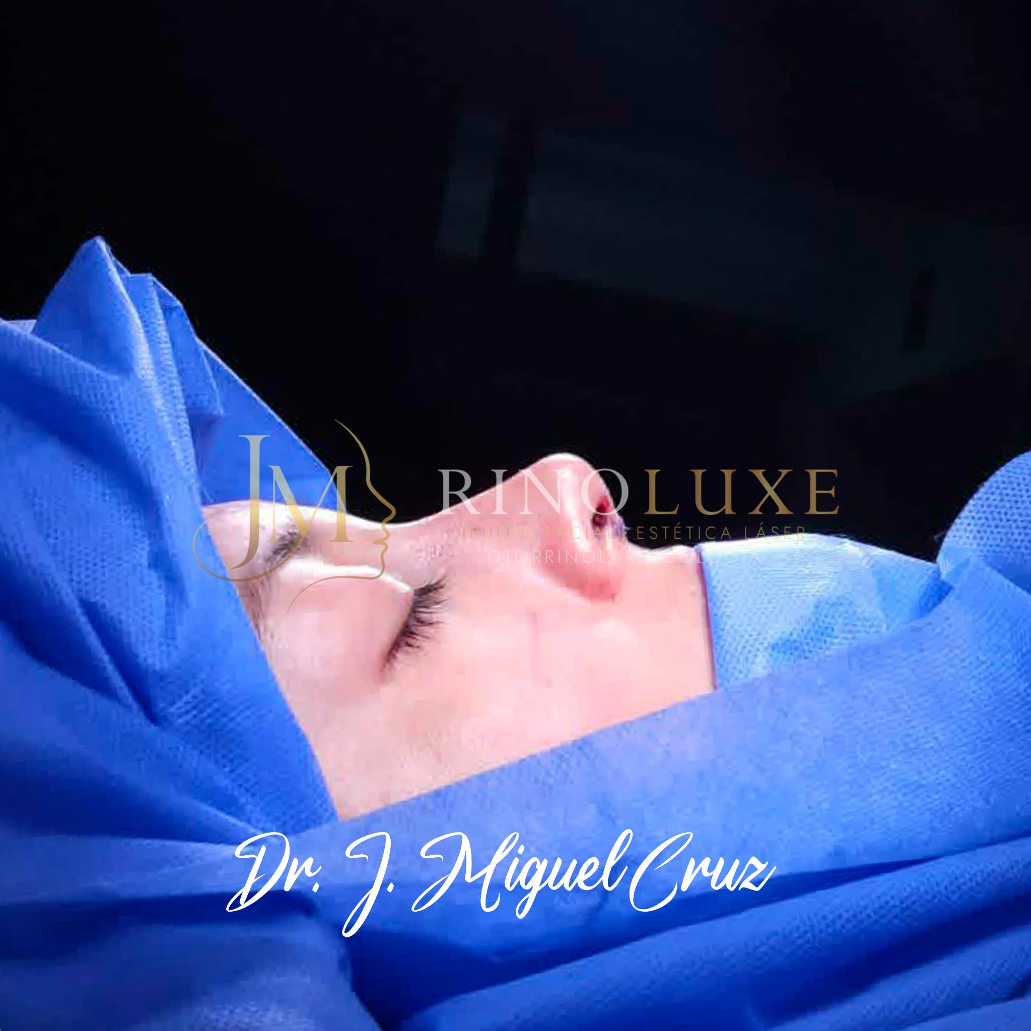 Fotografía clínica de rinoplastia 1