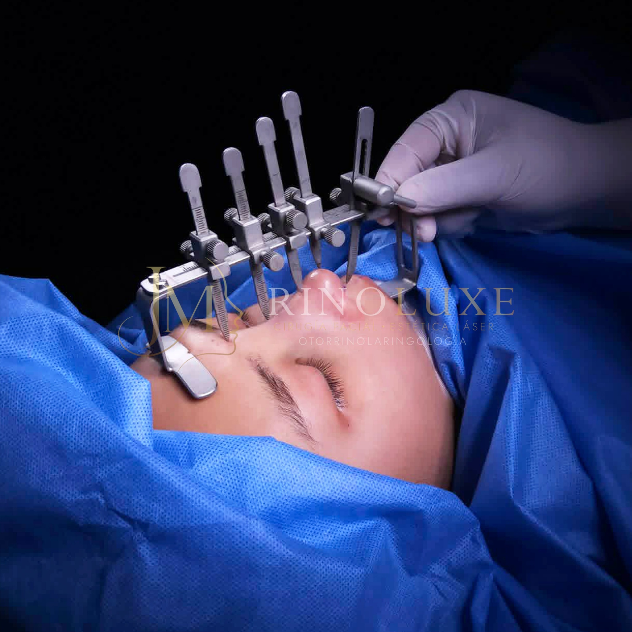 Fotografía clínica de rinoplastia 3