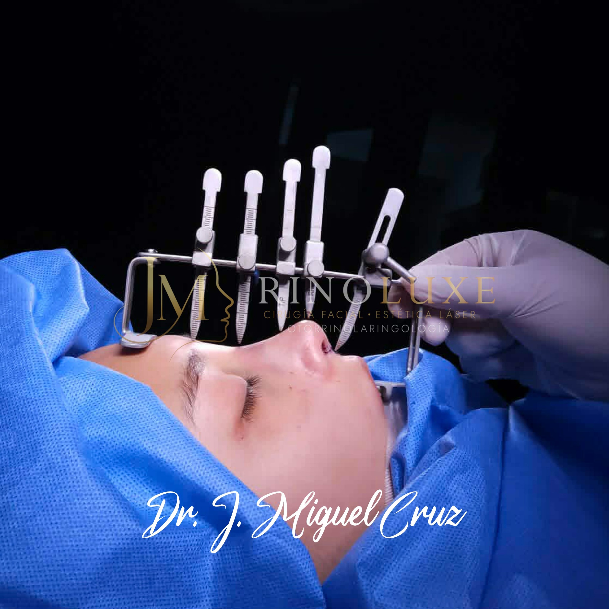Fotografía clínica de rinoplastia 6