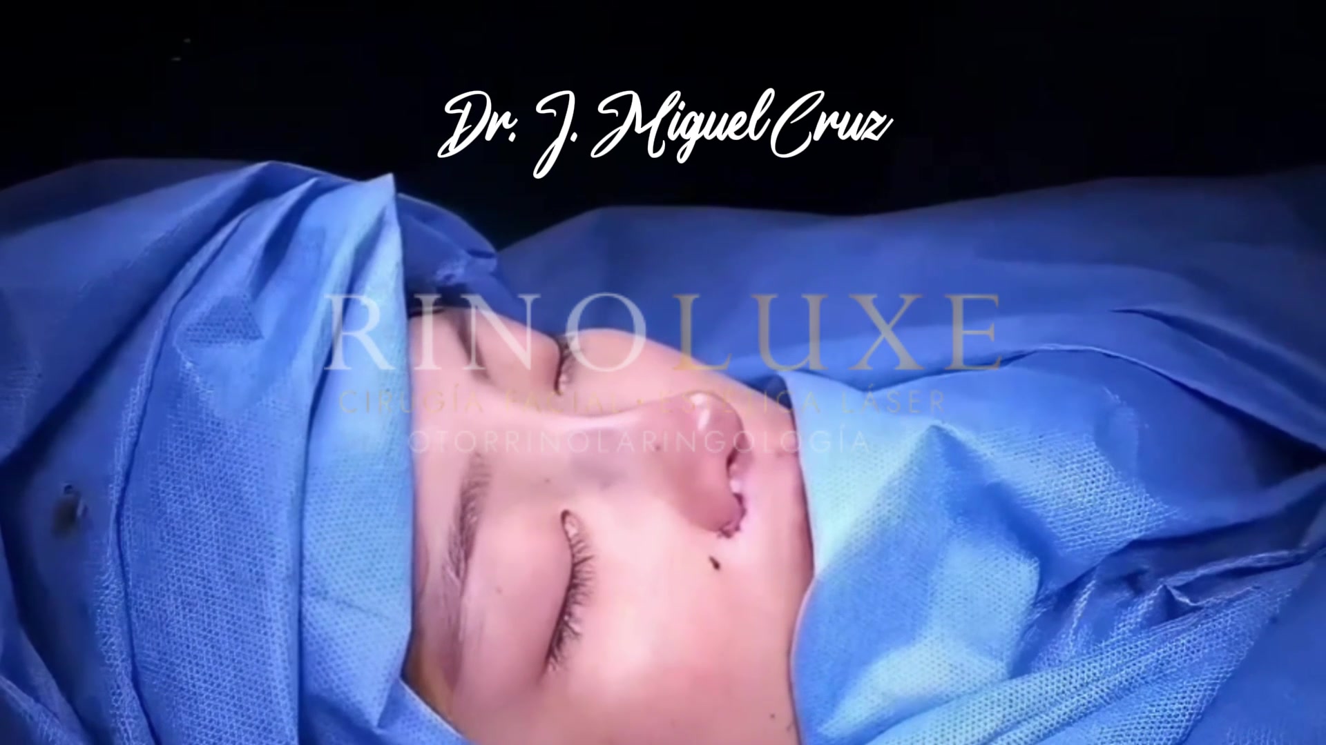 Video clínico de rinoplastia 2