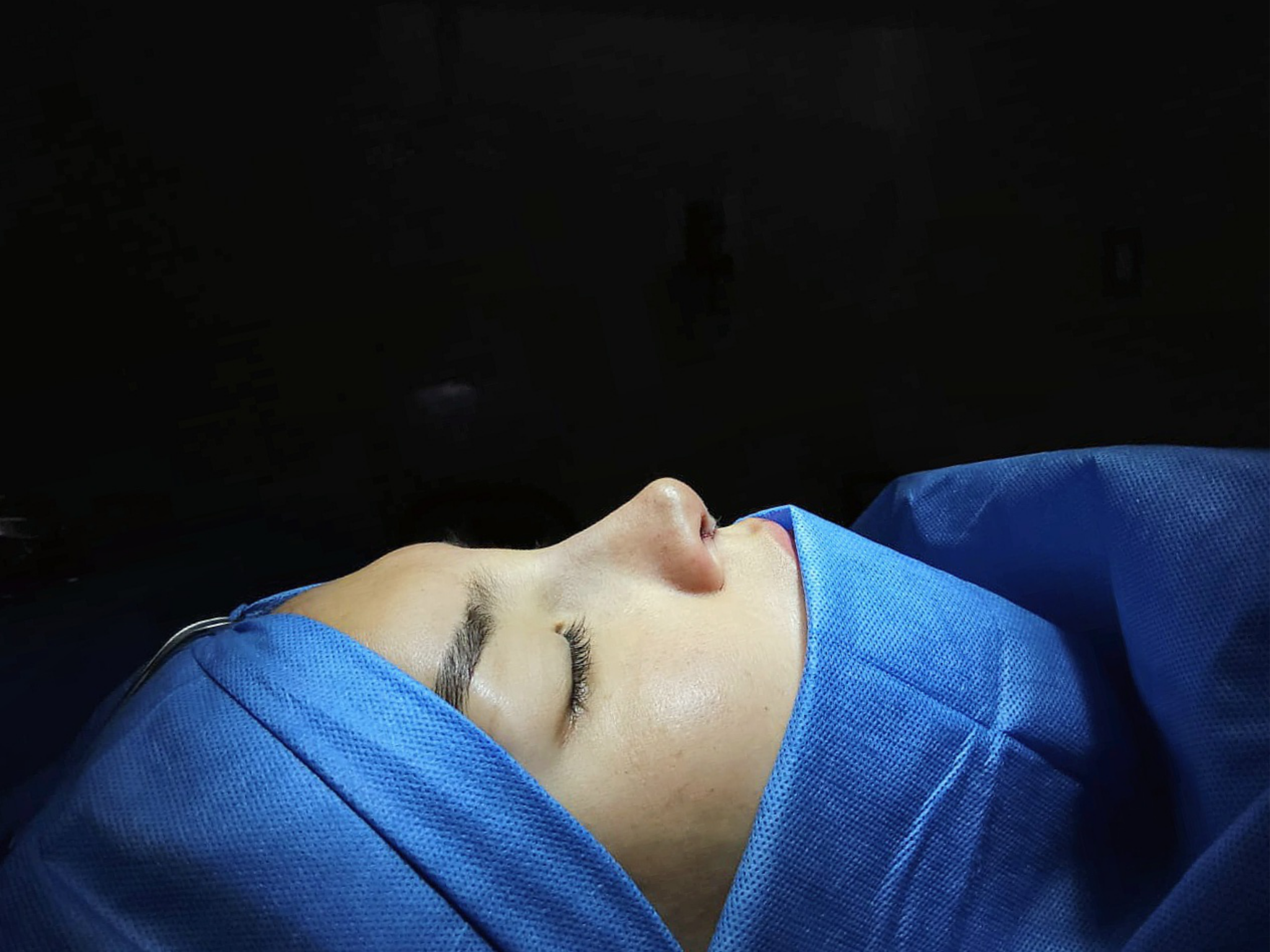 Rinoplastia RINOLUXE