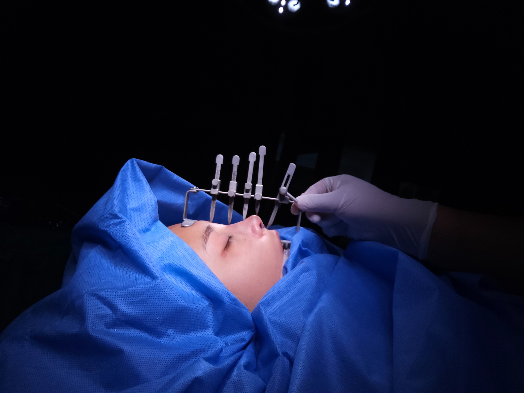 Rinoplastia RINOLUXE