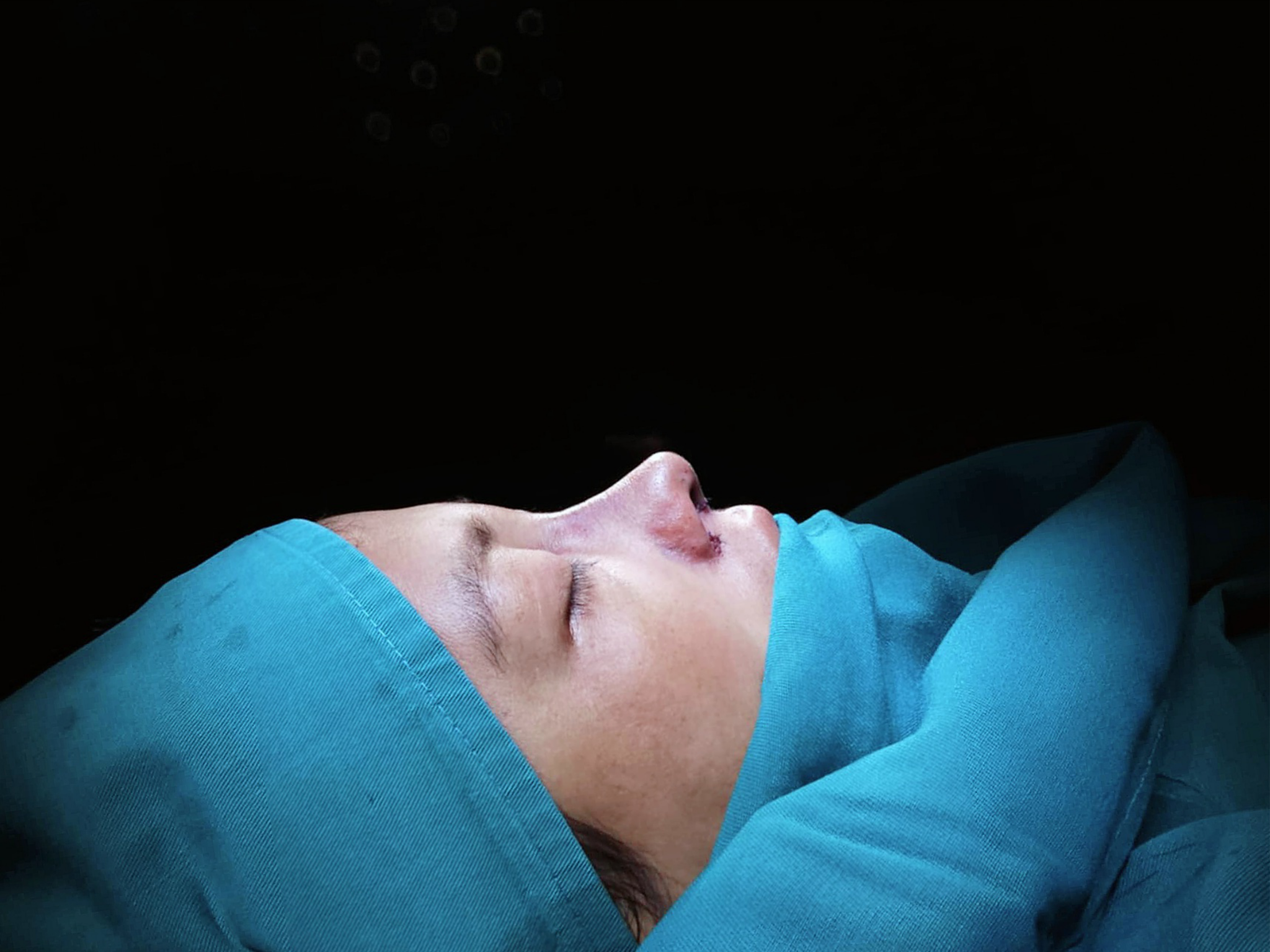 Rinoplastia RINOLUXE segunda vista