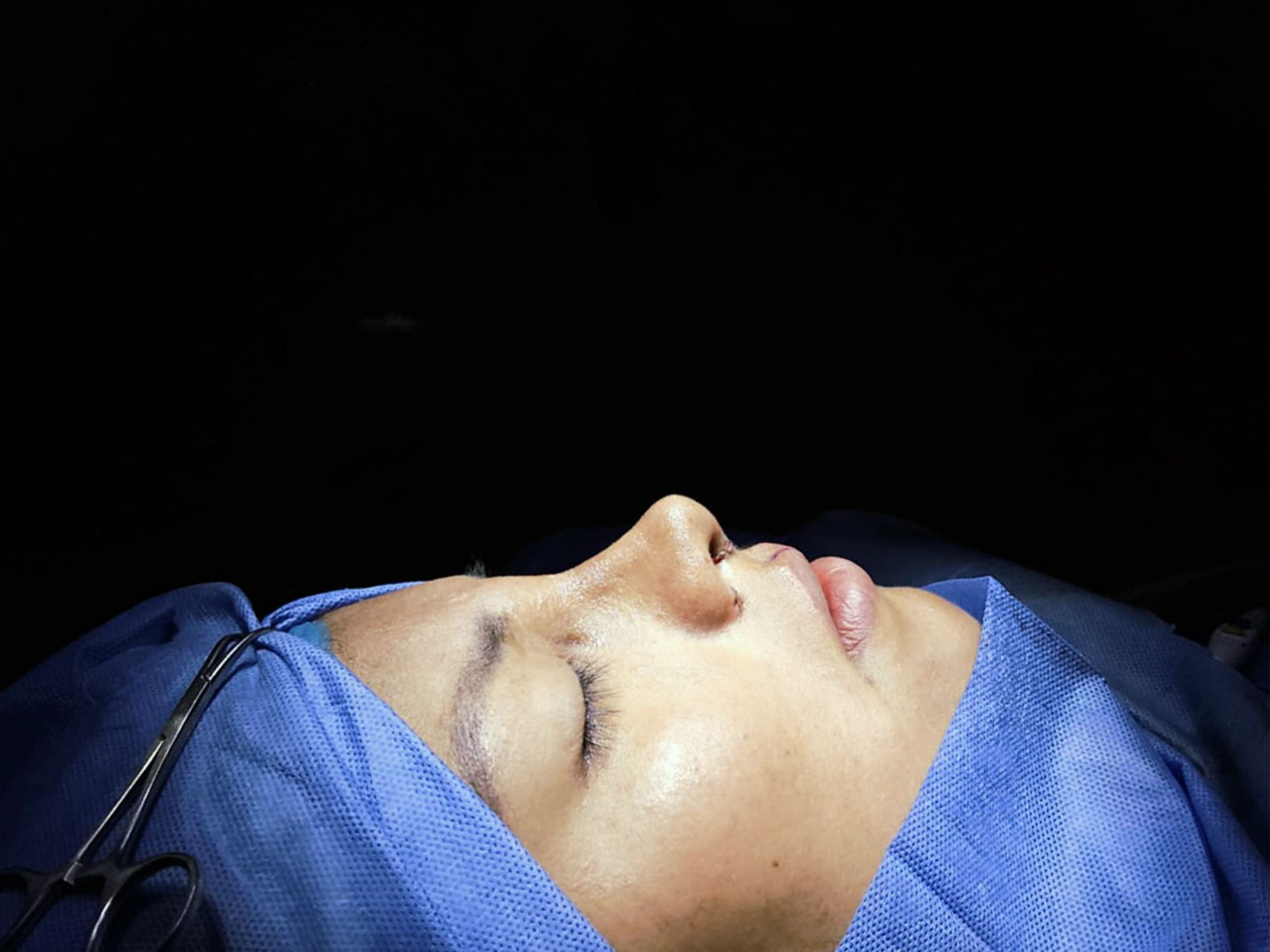 Rinoplastia RINOLUXE tercera vista