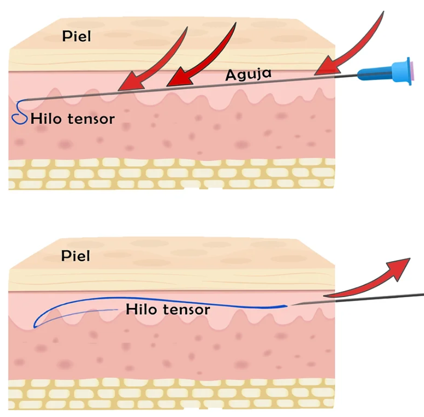 Hilos tensores