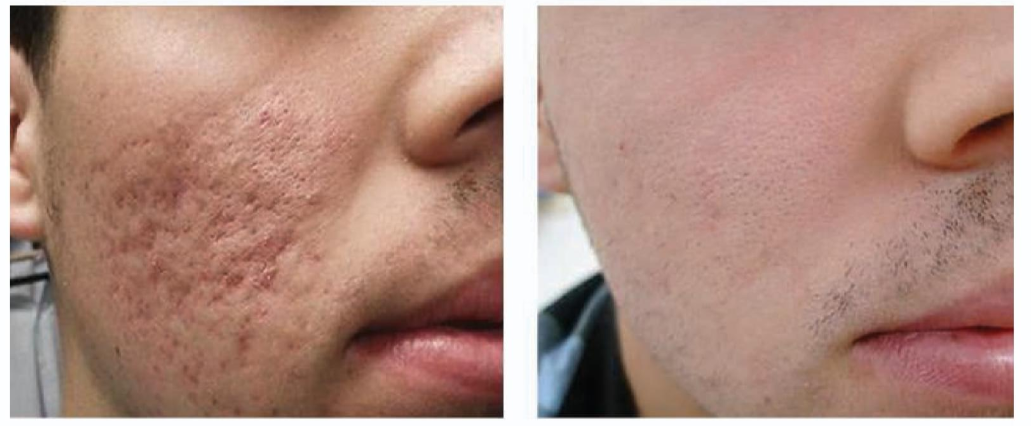 Tratamiento de láser en acné antes y después