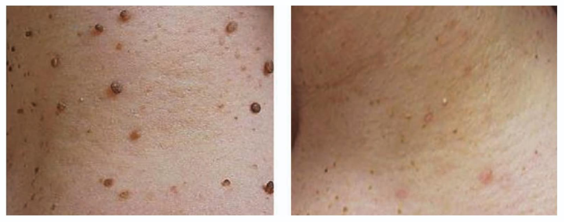 Tratamiento láser de acrocordones antes y después
