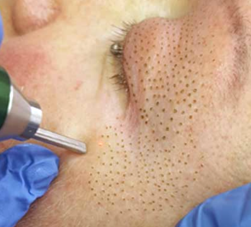 Blefaroplastia láser no quirúrgica