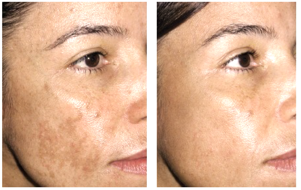 Tratamiento de melasma con láser, antes y después