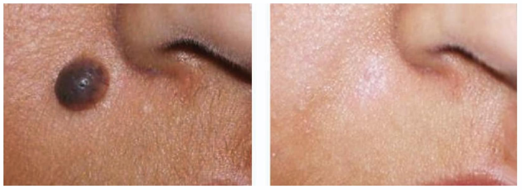 Tratamiento de nevus intradérmico con láser