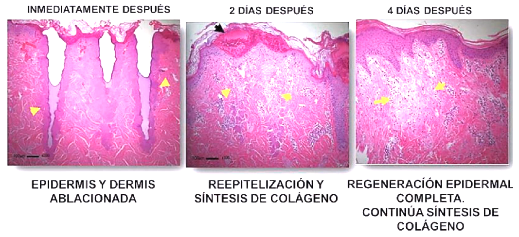 Regeneración de la piel luego del láser