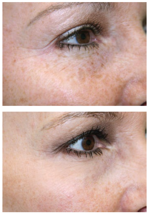 Rejuvenecimiento láser de pecas y arrugas, antes y después