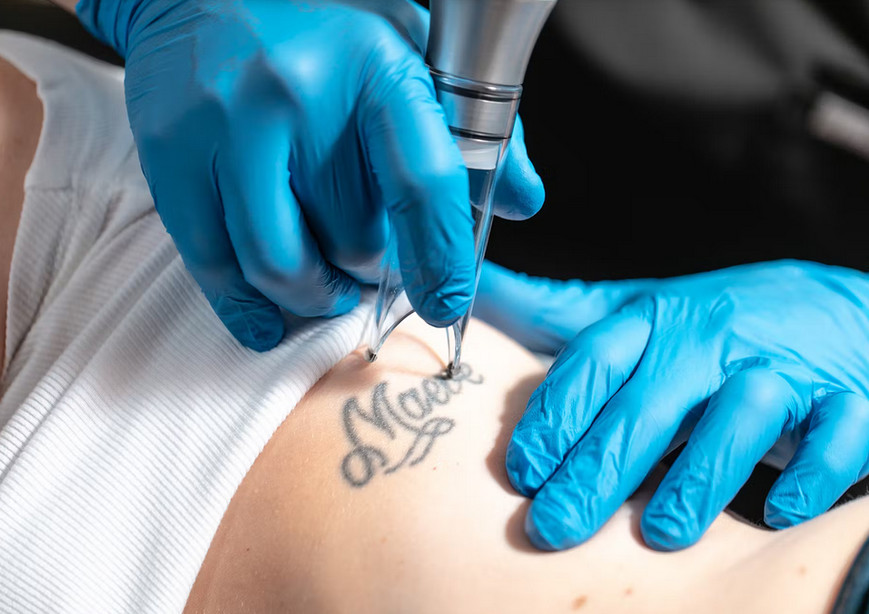 Atenuación de tatuajes con láser