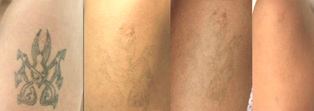 Secuencia de atenuación de tatuajes con láser