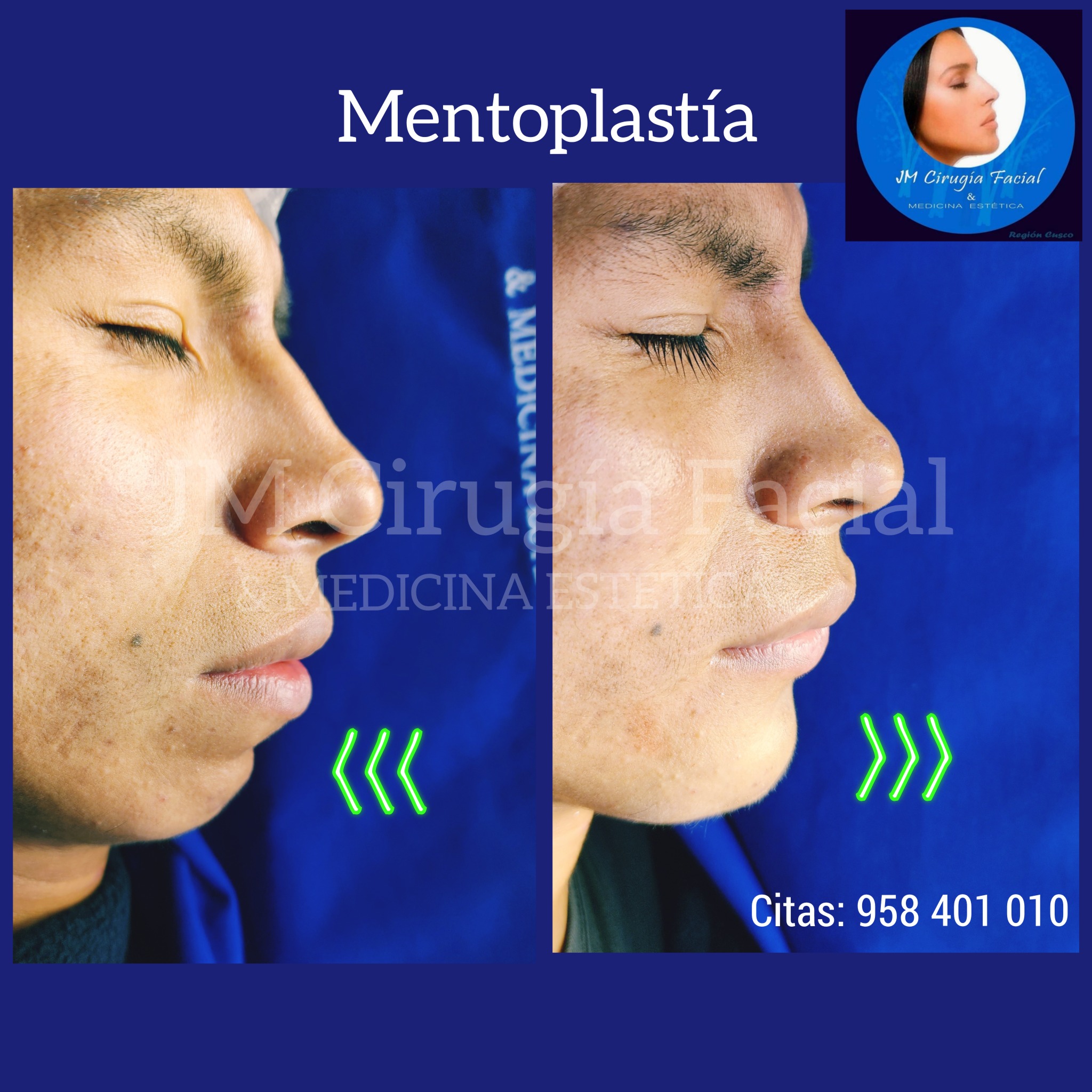 Mentoplastia