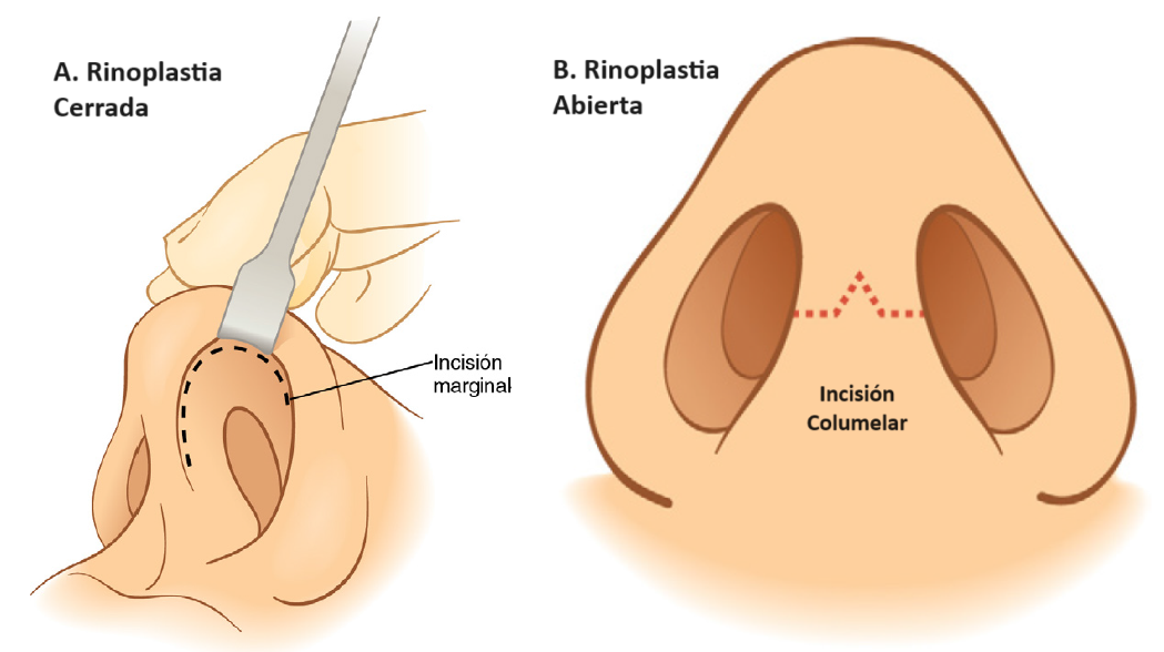Rinoplastia cerrada y abierta