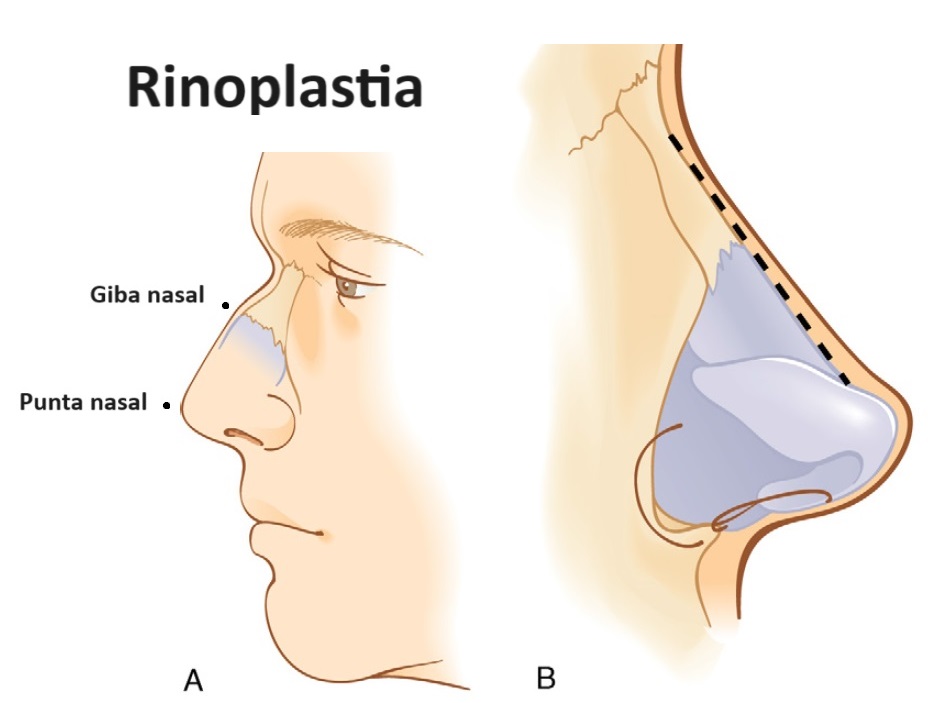 Diagrama de rinoplastia
