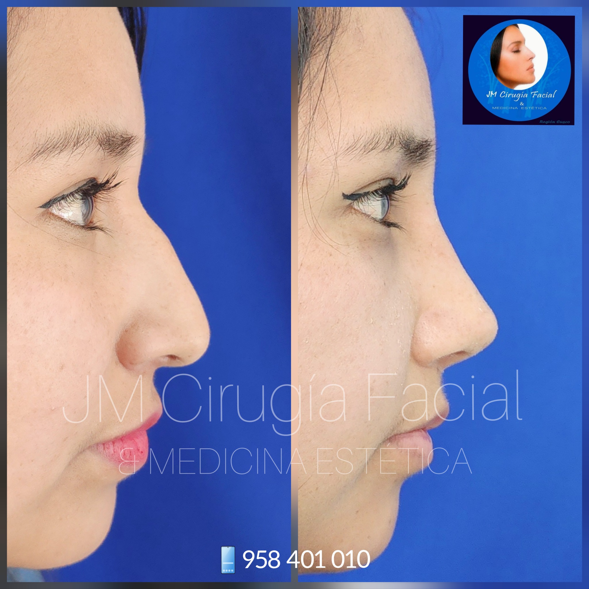Rinoplastia híbrida