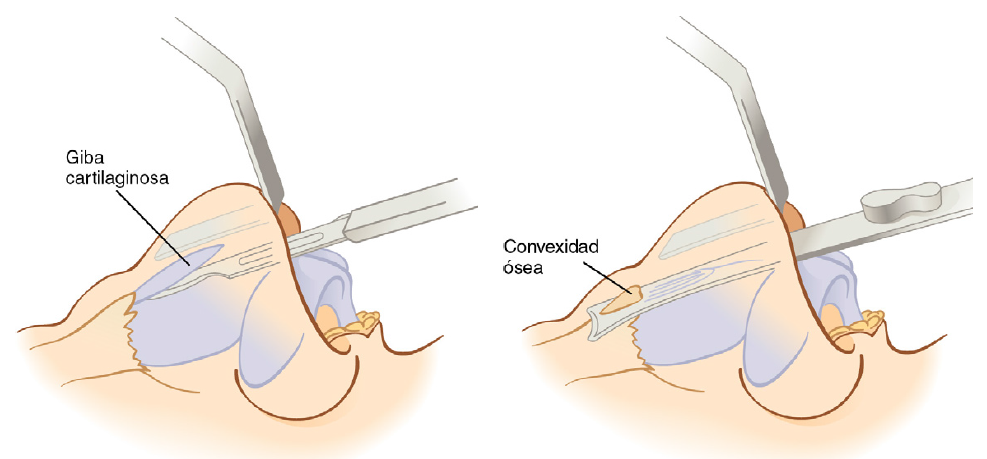 Rinoplastia convencional con osteótomos