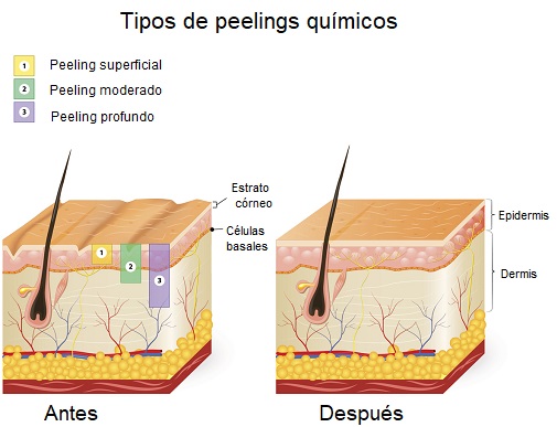 Tipos de peeling