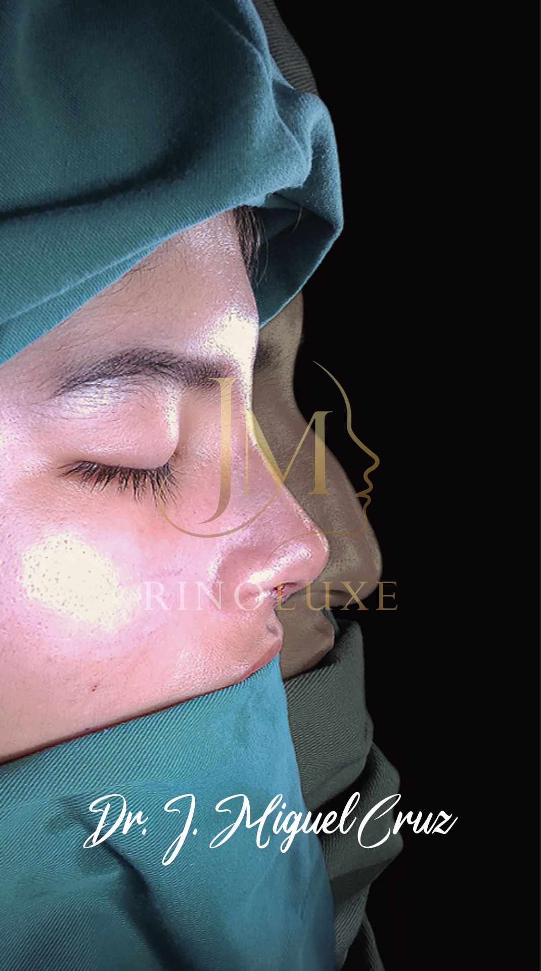 Trabajo de rinoplastia — caso 1