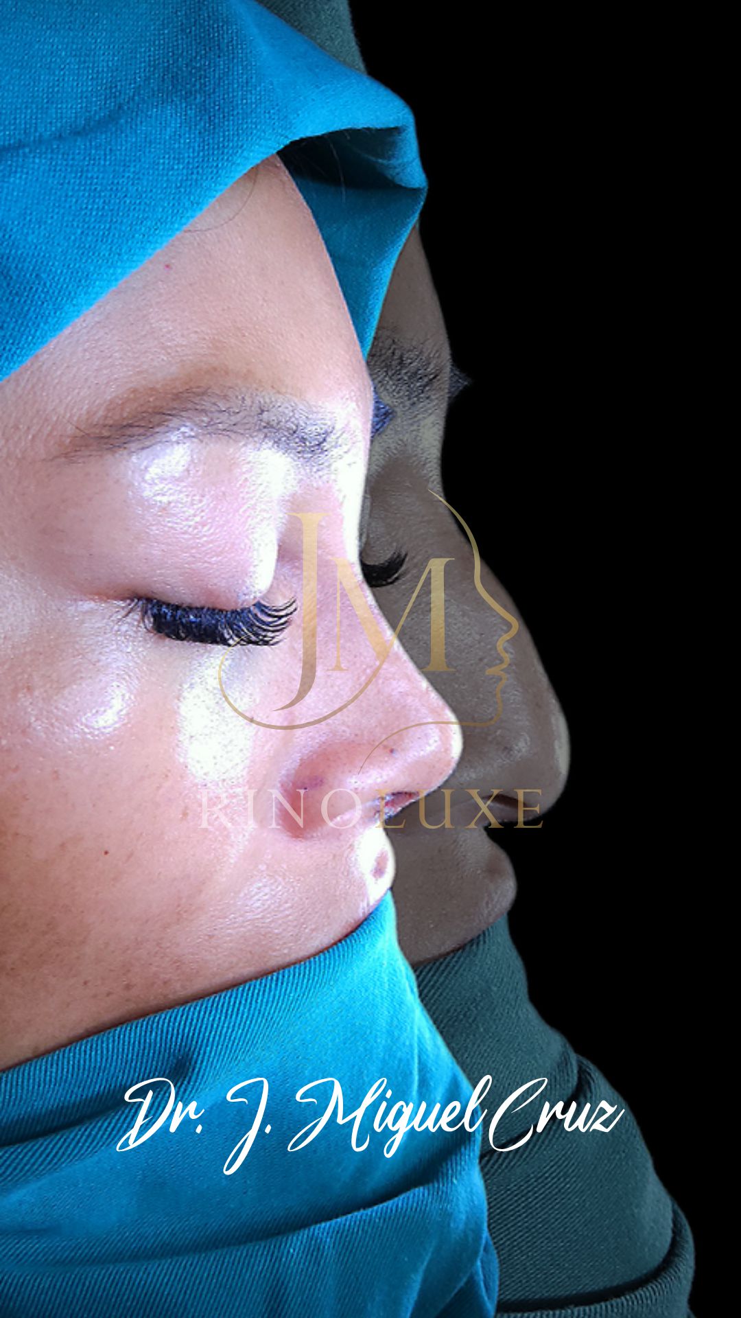 Trabajo de rinoplastia — caso 2