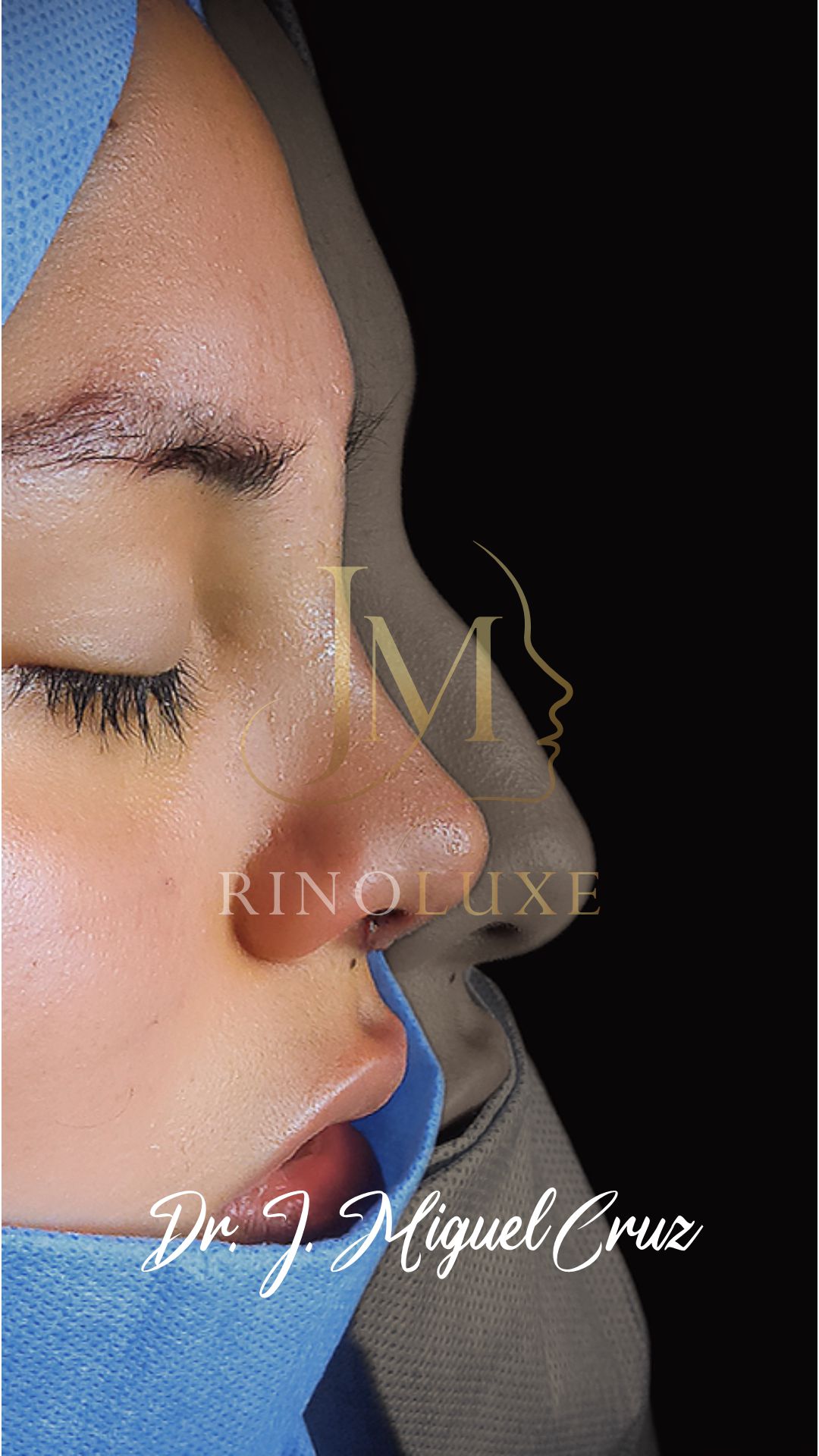 Trabajo de rinoplastia — caso 3